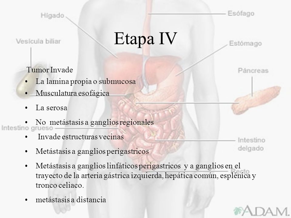 cáncer de próstata de cuarta etapa e cáncer de próstata de cuarta etapa e